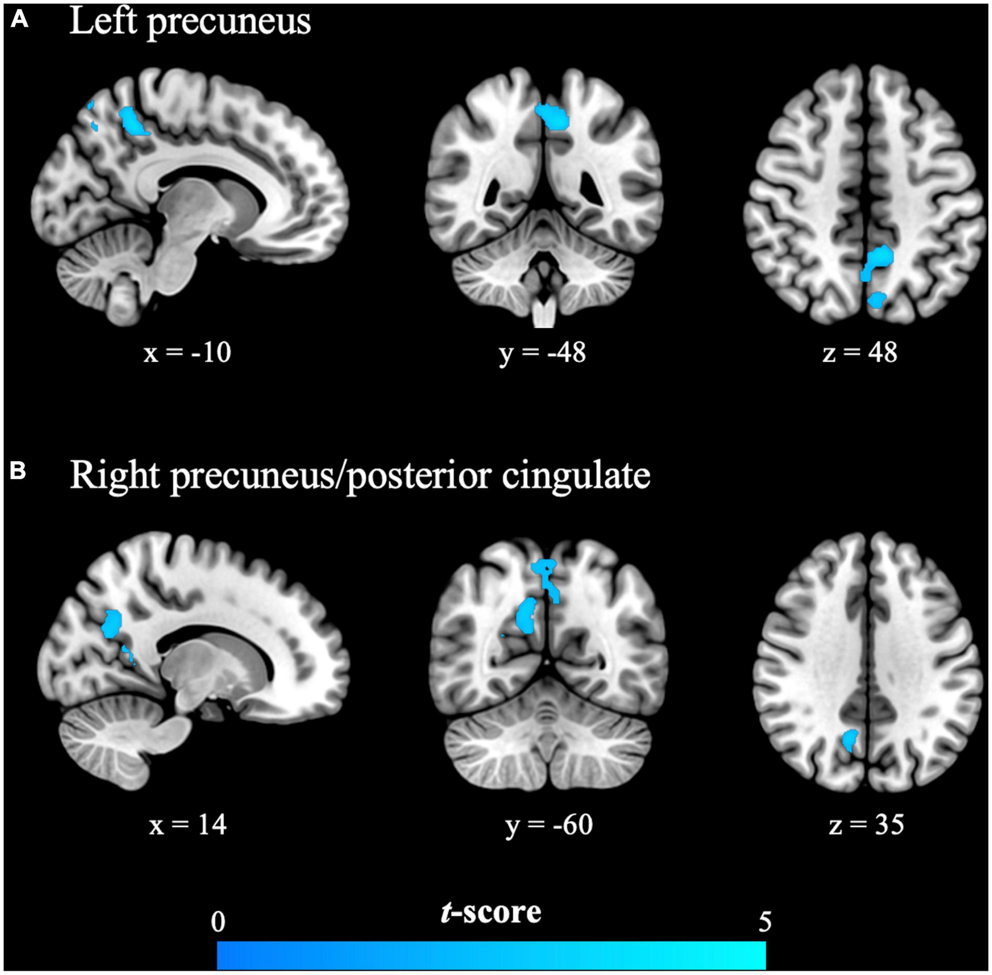 Adaptive neuroplasticity in the default mode network contributing to absence of central sensitization in primary dysmenorrhea